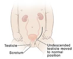 Image result for Undescended Testicle