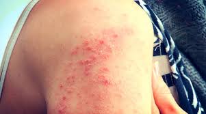 10+ Eczema Facts Causes, Symptoms, And Treatments