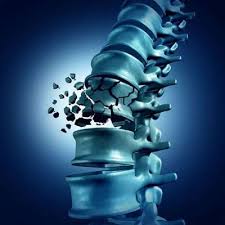 Image result for Vertebral Compression Fracture