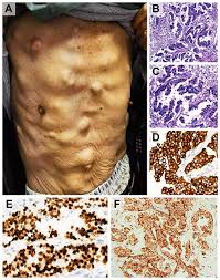 This growth can spread beyond the lung by the process of metastasis into nearby tissue or other parts of the body. Cutaneous Metastasis As The First Presentation Of Non Small Cell Lung Ott