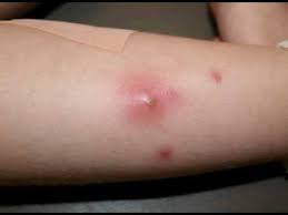 Orang yang aktiv seksual memiliki resiko terkena virus hpv penyebab penyakit kelamin, hampir 70% orang yang aktiv. Penyebab Bisul Di Vagina Dan Cara Mengobatinya Theasianparent Indonesia