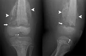 Ijms | Free Full-Text | The Formation Of The Epiphyseal Bone Plate Occurs  Via Combined Endochondral And Intramembranous-Like Ossification