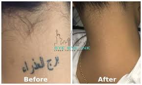 Many acne scars result from a loss of collagen in the skin. Laser Tattoo Removal Ny Bye Bye Ink Best Reviews Best Laser Picoway