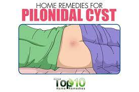 Most doctors think that ingrown hairs are the reason for many of them. Home Remedies For Pilonidal Cysts Large Pimple At Bottom Of Tailbone Top 10 Home Remedies Ingrown Hair Pilonidal Cyst Skin Infection