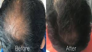 If you are suffering from hair loss and/or interested in treatments, you may have seen products that claim to block dht. Regrow Your Own Hair Using Microneedling With Prp And Rf