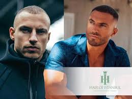 Antonio Banderas Hair Transplant Speculations: Fact or Fiction?