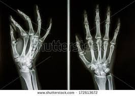 Film X Ray Show Bones Of Human Hands Stock Photo Human Bones Human Human Hand