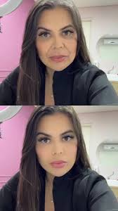 Harmonização Facial Do Xand Carla Perez