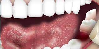 Bleeding Tooth Socket After Extraction Portal Myhealth
