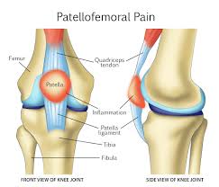 Image result for Patellar Tilt Test