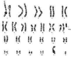 Https Www Rarechromo Org Media Information Chromosome 2022 Cat 20eye 20syndrome 20ces 20qfn Pdf