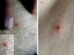 Image result for infected tick bite