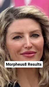 Check out these incredible Morpheus8 Results! , No wonder it's the Number 1  Skin remodeling treatment in the world!, Morpheus8 combines microneedling  with radio frequency (ie heat) to:, ✨stimulate ...