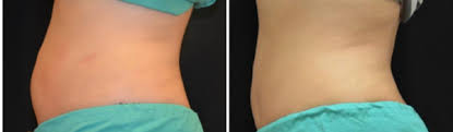 Coolsculpting Tupelo Fat Freezing North Ms Accent Plastic Surgery