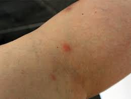 Image result for spinne biss haut reaktion