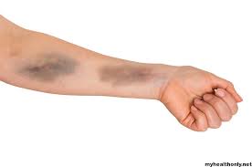 Further it is subdivided into four types based on the kind of white. Know About What Symptoms Of Blood Cancer My Health Only