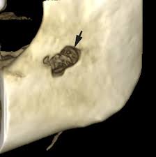 Image result for Alveolitis sicca)