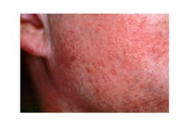 Image result for red rash face