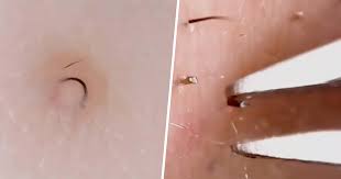An ingrown hair occurs when a shaved or tweezed hair grows back into the skin. Hole In Armpit From Ingrown Hair A Pictures Of Hole 2018