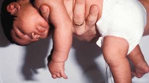 Image result for Floppy Infant