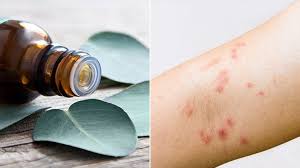 It also has antibacterial and antifungal properties that help keep skin healthy and fight skin allergies and yeast infections that may be responsible for rashes, dermatitis and thinning hair, says. Best Natural And Essential Oils For Eczema Everyday Health