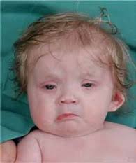 Mutations in the cyclin family member FAM58A cause an X-linked dominant  disorder characterized by syndactyly, telecanthus and an