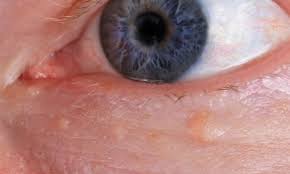 Image result for xantelasma