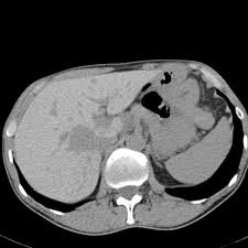 Hepatic Attenuation On Ct Radiology Reference Article Radiopaedia Org