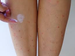 Image result for mosquito bite