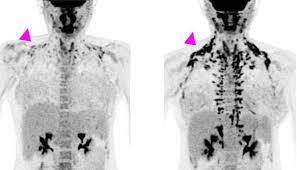 Maybe you would like to learn more about one of these? Drug Activates Brown Fat Improves Glucose Metabolism In Healthy Women National Institutes Of Health Nih