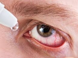 C3a er en betennelsesmediator og fører til kardilatasjon og kjemotakse. Lacrimal Kanal Betennelse I Takesekken Behandling Metoder For A Bli Kvitt Patologier Ved Hjelp Av Tradisjonelle Og Folkemedisiner