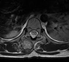 Image result for Spinal Epidural Abscess