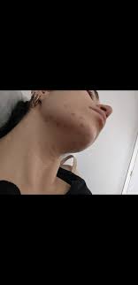 Their extra consumption of vitamins affected how. Acne Warning To All Those Who Supplement With B Vitamins Be Careful With Excessive B12 Skincareaddiction