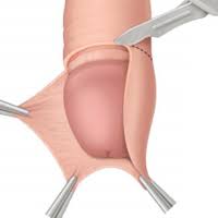 Cirugia De Circuncision Clinica San Marcos