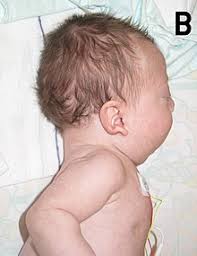 Noonan Syndrome Wikipedia