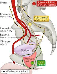 There is some disagreement among medical organizations whether the benefits of testing outweigh the potential risks. Salvage Therapy At Biochemical Recurrence Of Prostate Cancer Nature Reviews Urology