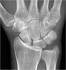 Image result for Wrist XRay