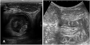 Image result for Intussusception
