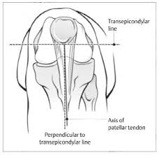 Image result for Ballottable Patella Sign