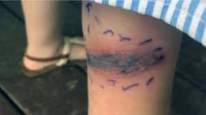 The black widow spider rarely bites people, but when it does, its venom can cause an unpleasant reaction. Black Widow Spider Bite Sends 5 Year Old Girl To Emergency Room Cbs News