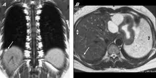 If so, the doctor may. Mri Features Of Pleural Endometriosis After Catamenial Haemothorax Thorax