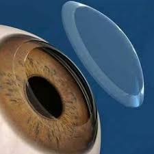 و كشفنا عنك غطاءك فبصرك اليوم حديد Laser Vision Correction Eye Health Corneal Transplant