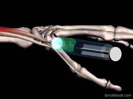 Image result for Tendon Sheath Injection