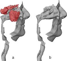 Labeled nasal cavity, sinuses and ear images. A Deformable Template Method For Describing And Averaging The Anatomical Variation Of The Human Nasal Cavity Bmc Medical Imaging Full Text