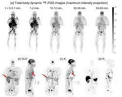 Pet scanners work by detecting the radiation given off by a substance injected into your arm called a radiotracer as it collects in different parts of your body. Total Body Dynamic Pet Successfully Detects Metastatic Cancer First Patient Results