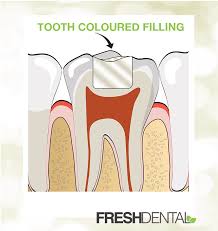 Tooth Fillings in Concord NC