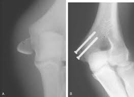 Medial epicondyle apophysitis, often called little league elbow, is the most common injury affecting young baseball pitchers whose bones have not yet stopped growing. Articular Injuries In The Athlete Clinical Gate