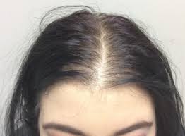 There are no safety data for the treatment of uncomplicated duodenal ulcer beyond 8 weeks. Evaluation Of Hair Loss In A Primary Care Setting 2018 10 19 Relias Media Continuing Medical Education Publishing