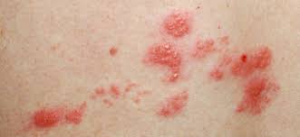 Image result for herpes zoster