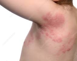 Image result for shingles in children